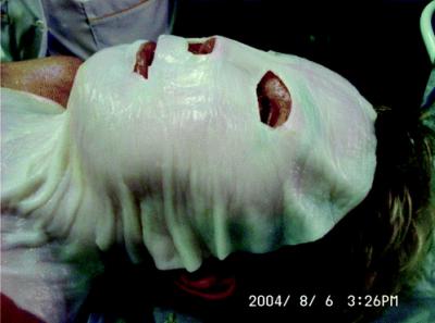 Microbial Cellulose Membrane