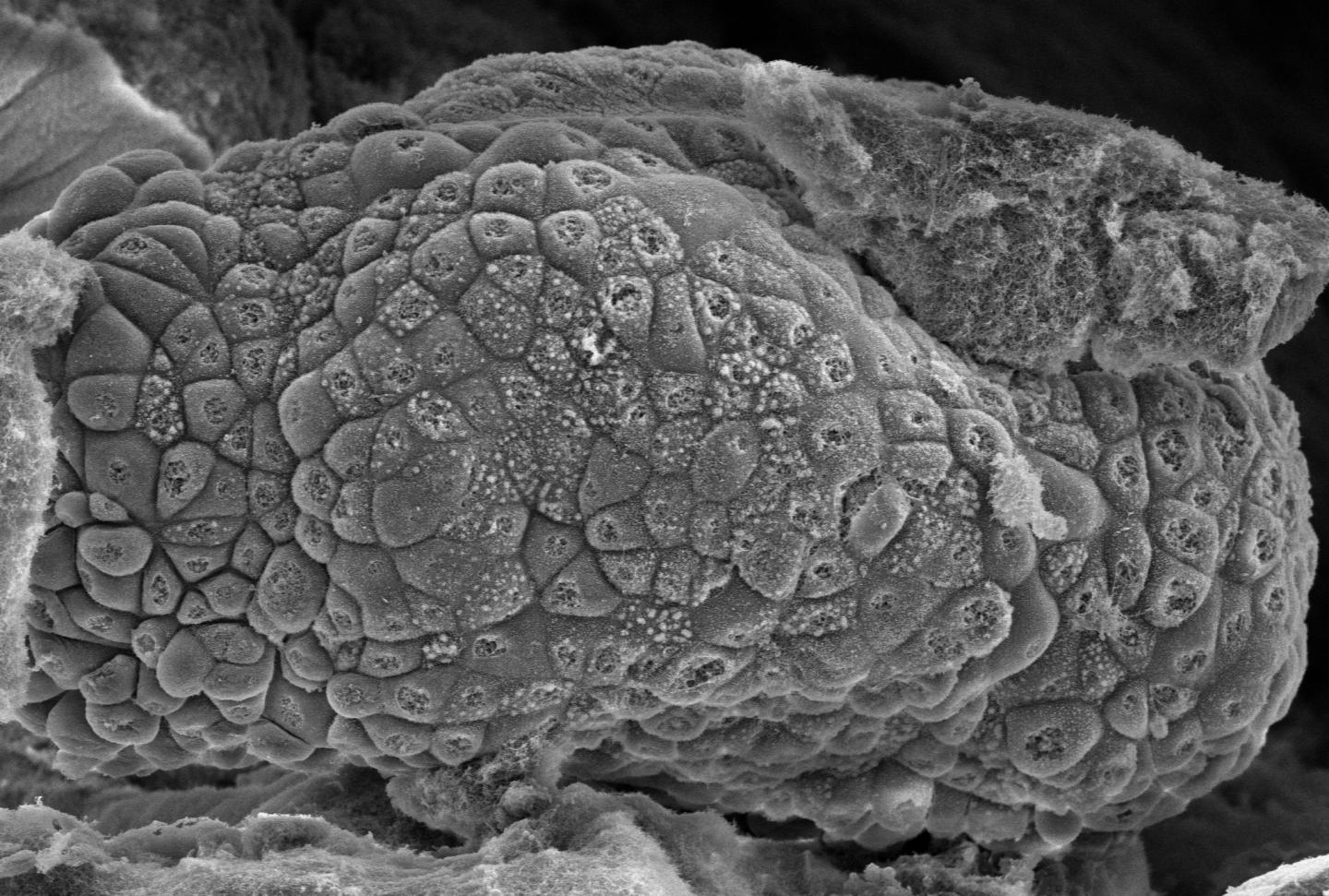 Cancer cells in biomaterial