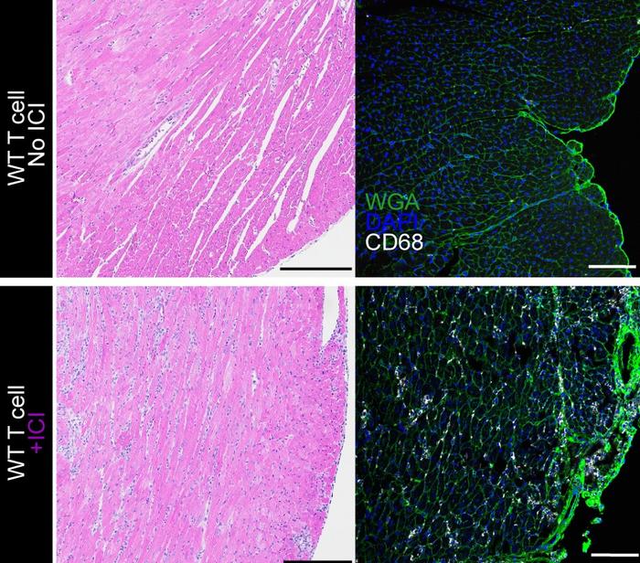 A complication of immune checkpoint inhibitors