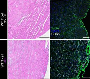 A complication of immune checkpoint inhibitors