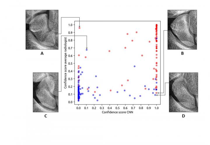 Researchers Use AI to Detect Wrist Fractures