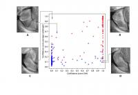 Researchers Use AI to Detect Wrist Fractures