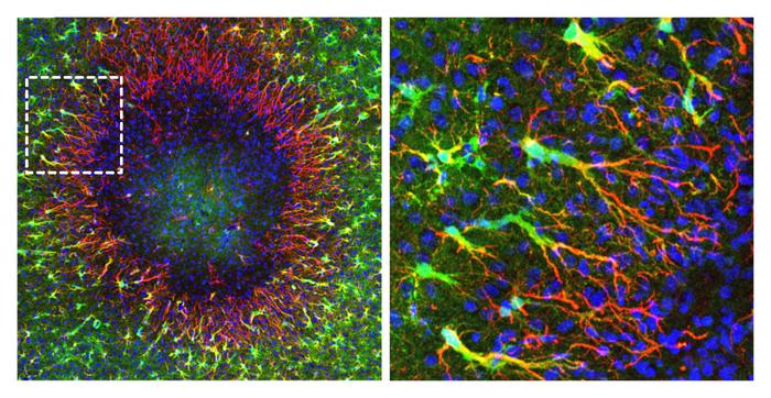 Brain lesion with regenerative astrocytes