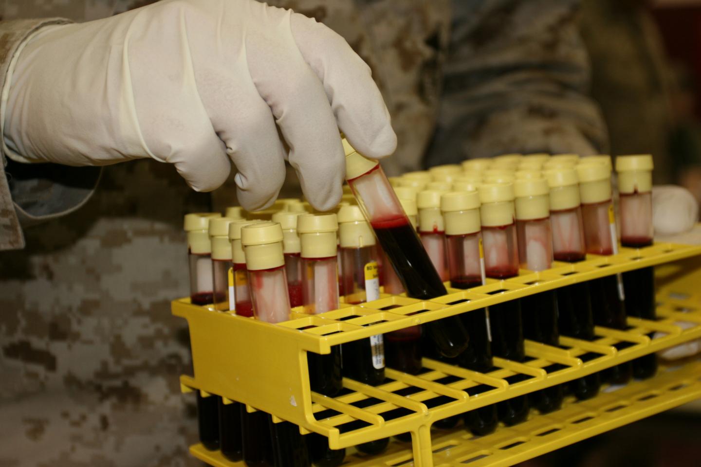 Study May Explain Why Cholera Severity Varies with Blood Type