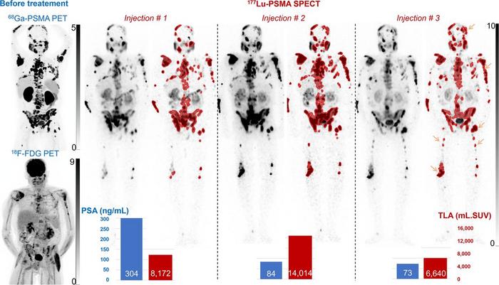 Maximum-intensity projection images from [68Ga]Ga-PSMA and [18F]-FDG PET before treatment, and [177Lu]Lu SPECT displayed without and with (red) segmentation with SUV of >3 in 74-y-old mCRPC patient.