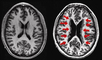 Brain Structure in Periventricular Nodular Heterotopia