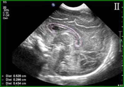 Ultrasonic Image of the Corpus Callosum
