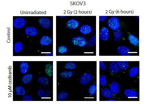 An Anticancer Treatment Attacks Ovarian Cancer from Multiple Angles (1 of 1)