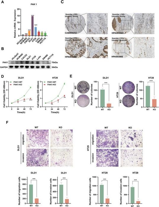 PAK1 deficiency inhibits CRC progression