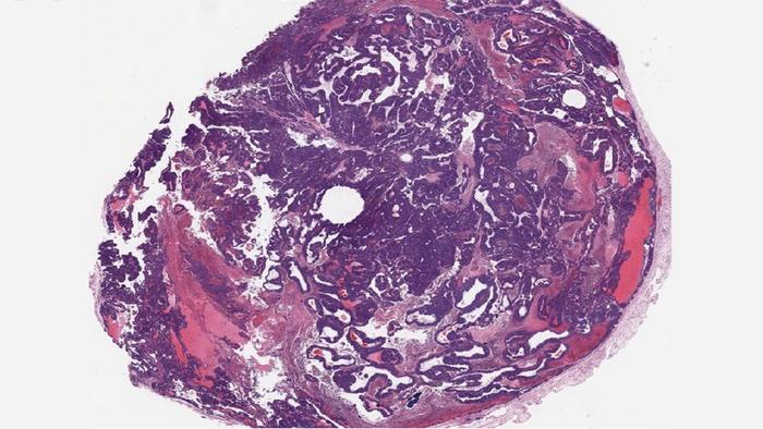 BPTF knockout tumor