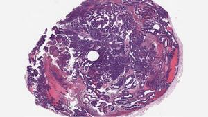 BPTF knockout tumor