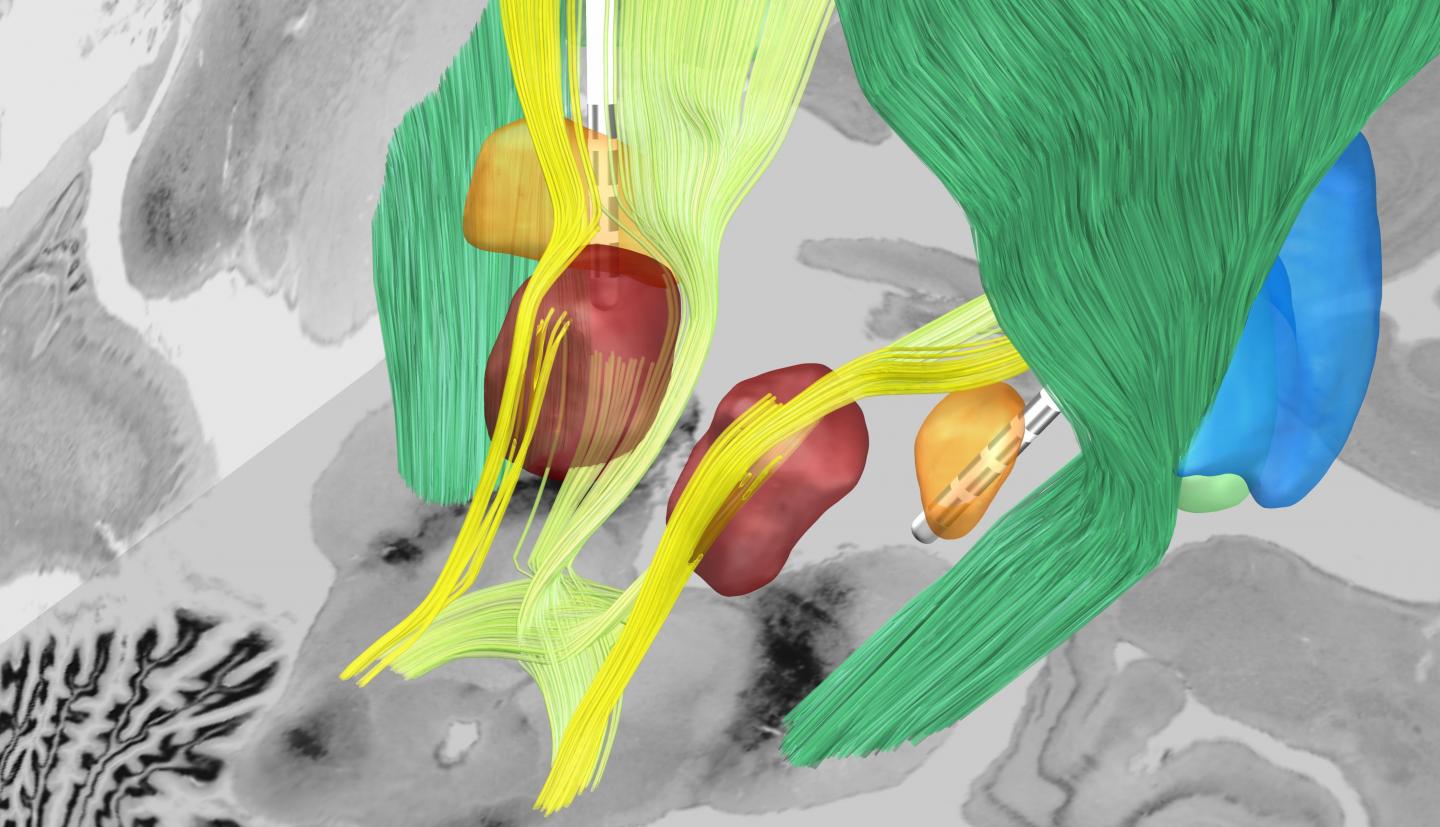 Deep Brain Stimulation