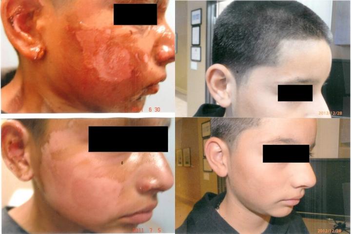 5 Days of Application of Curcumin Gel
