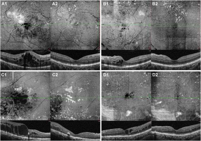OCTA en-face and B-scan images demonstrated a significant improvement and stabilization of four DME eyes from the “1 + 1 + PRN” group.