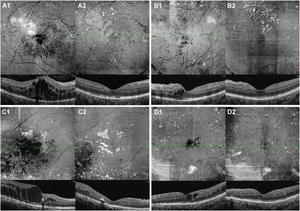 OCTA en-face and B-scan images demonstrated a significant improvement and stabilization of four DME eyes from the “1 + 1 + PRN” group.