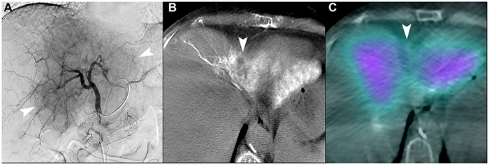 Figure 7: Unfavorable macrovascular and microvascular arterial conduit in two patients with intrahepatic cholangiocarcinoma
