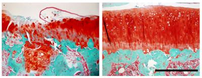 TGF-beta1 Antibodies Effectively Halt Osteoarthritis in Mice
