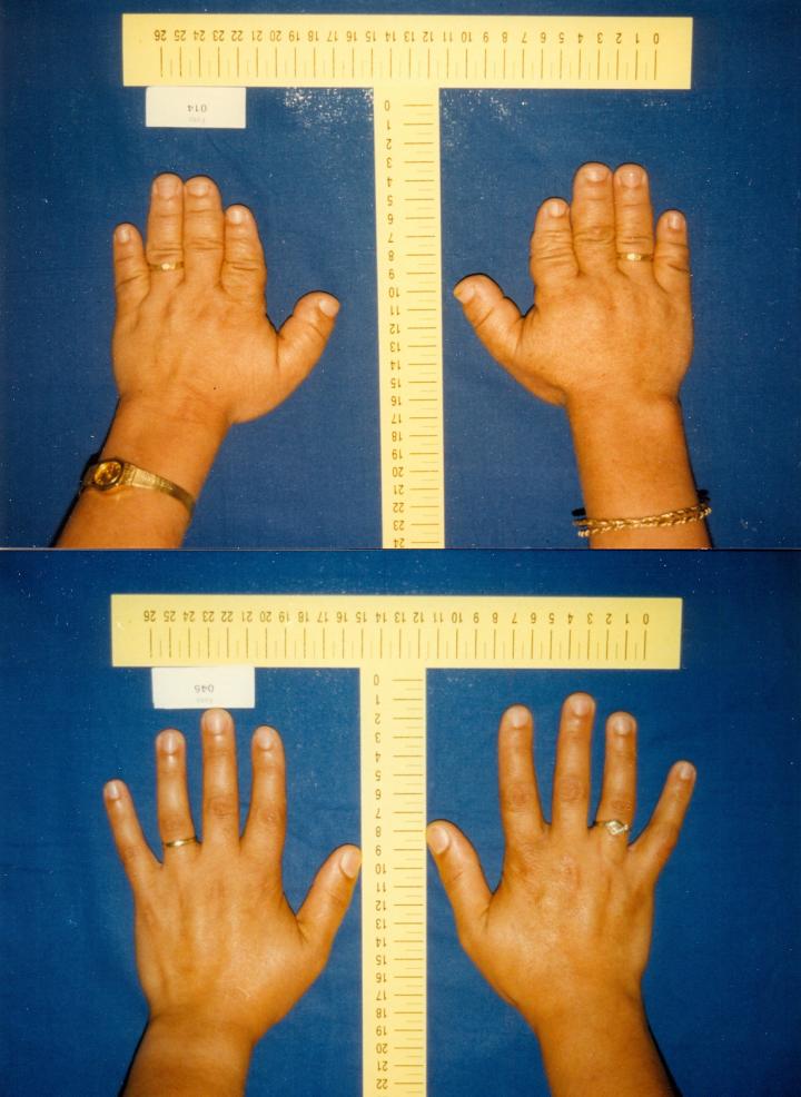 Shortened Fingers