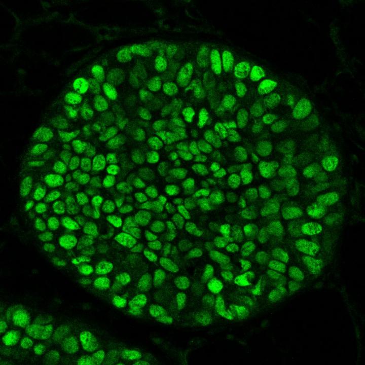 Immunofluorescence Staining on a Breast Cancer