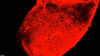 Human Amyloid Buildup