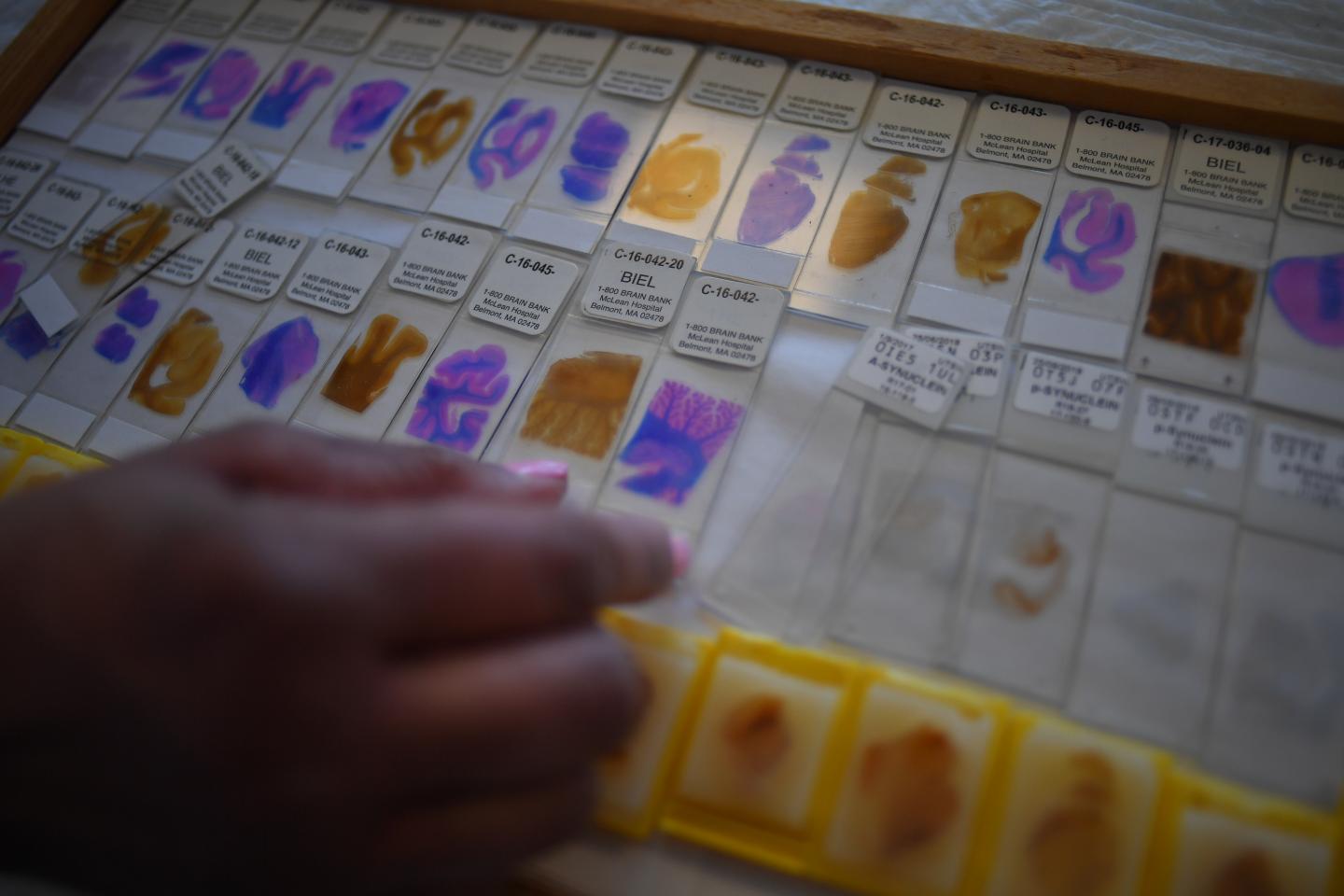 McLean's Brain Bank Receives New Contract From NIH