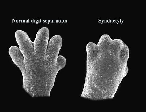 Normally separated digits and fusion of the digits
