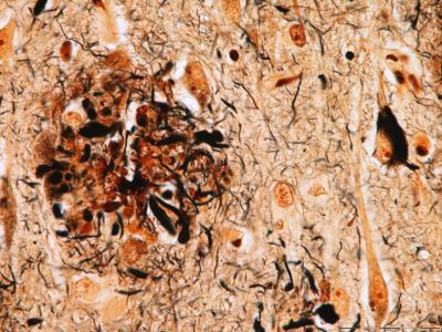 The Challenges Ahead for Alzheimer’s Disease (2 of 5)