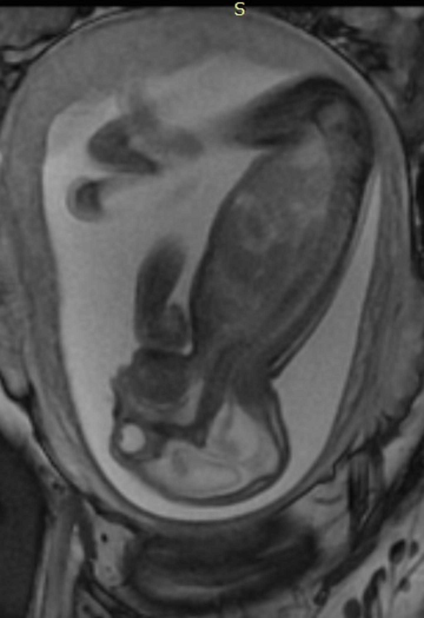 Figure 2: Side View of Fetus