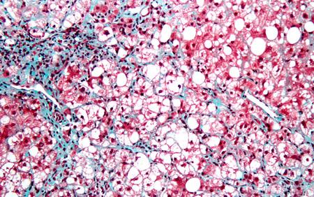 Steatohepatitis
