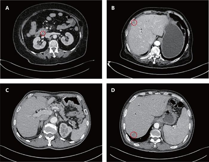 Imaging progression patterns by histologic subtype.