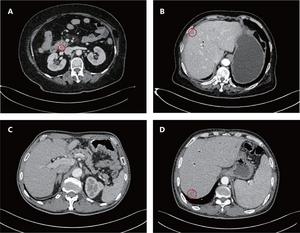 Imaging progression patterns by histologic subtype.