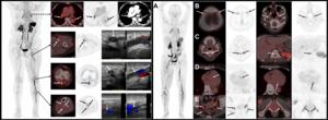 SNMMI Image of the Year: Novel PET Tracer Detects Deep Vein Thrombosis Clots in Legs and Lungs