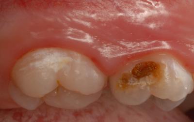 Tooth decay