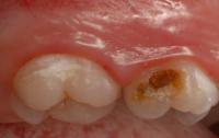 Tooth decay