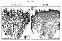 CCM Retina