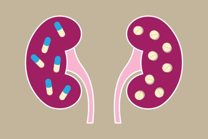 Heartburn Drugs May Cause Chronic Kidney Damage