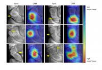 Researchers Use AI to Detect Wrist Fractures