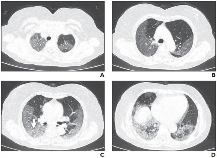 63-Year-Old Woman with Confirmed Coronavirus Disease (COVID-19), Severe Type