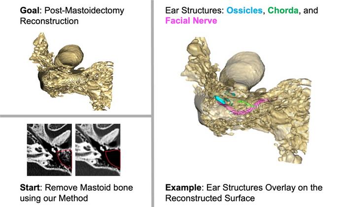 3D Post-Mastoidectomy Reconstruction
