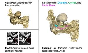 3D Post-Mastoidectomy Reconstruction