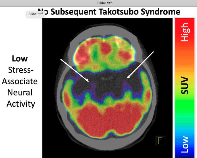 Stressed brain linked to broken heart