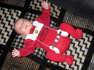 Infant wearing harness to correct congenital developmental dysplasia of the hip (DDH)