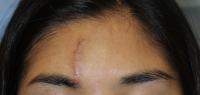 Scar at One Week