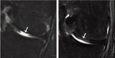 Articular Cartilage Replaced