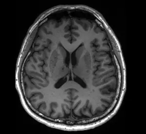 Image 4 - MRI image of a patient with enlarged perivascular spaces