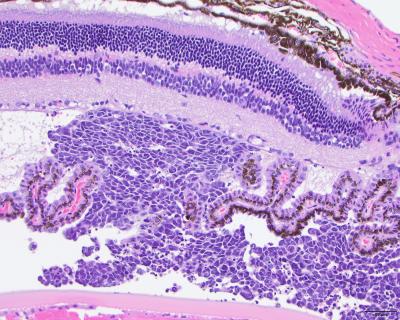 Rentinoblastoma -- Xenograft