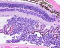 Rentinoblastoma -- Xenograft