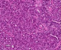 Aggressive, Metastatic Breast Tumor, Pre-Treatment