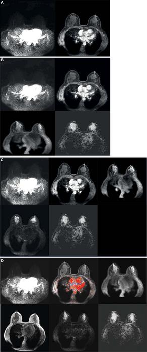 Breast MRI