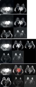 Breast MRI